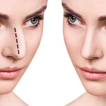 26a0a4a11e 50145722 rhinoplastie nez